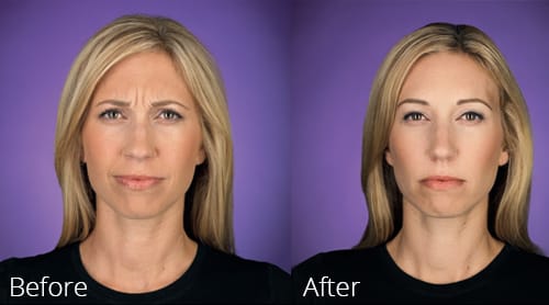 botox image