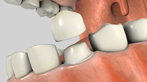 dental crown image