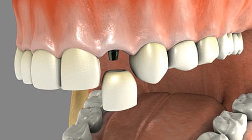 dental implant image